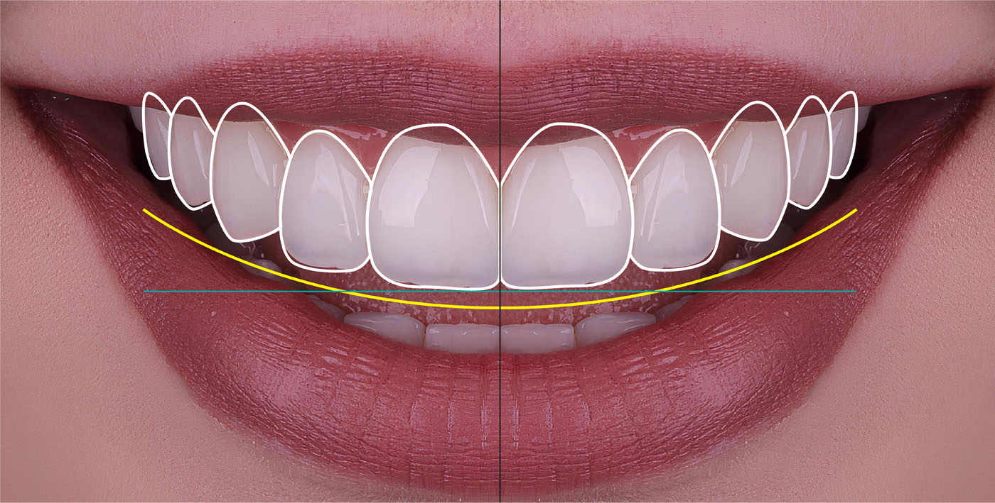 The image shows a person s smiling face with an overlay of a dental implant diagram indicating where the implant would be placed.