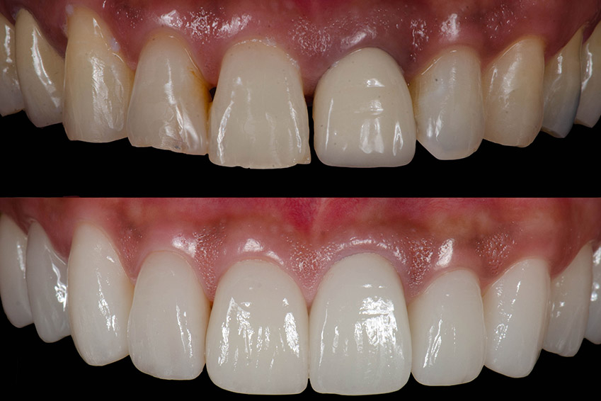 The image displays a close-up view of a person s teeth with visible staining, showcasing the results of teeth whitening treatment before and after application.