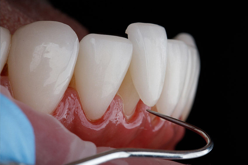 The image shows a close-up view of a mouth with teeth and gums, featuring an enlarged view of the lower front teeth and gumline, with a dental mirror reflecting the interior of the mouth and a dental tool visible in the foreground.