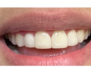 The image shows a person with a wide smile revealing their teeth, set against a plain white background.