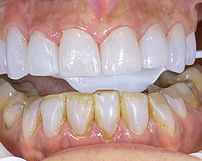 The image shows a close-up view of a person s teeth with yellow stains, some areas of decay, and a partial tooth restoration, which appears to be a bridge or implant.