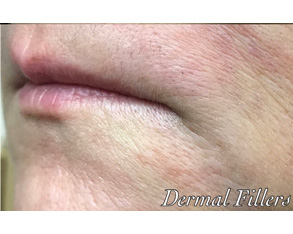 The image shows a close-up view of a person's chin area with visible skin imperfections, such as acne or blemishes, which are being treated by dermal fillers.