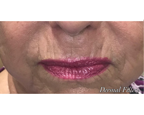 The image shows a close-up of a person's face with prominent lipstick application and visible skin texture, likely for cosmetic purposes.