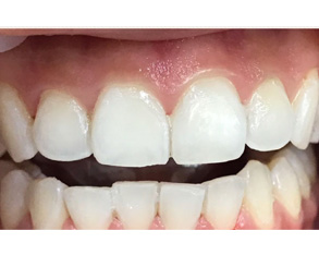 The image shows a close-up view of a person's teeth with a focus on their yellowed appearance and the presence of a gap between two front teeth.