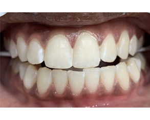 The image shows a close-up of a person's teeth with visible yellowing and staining, suggesting poor oral hygiene or dental issues.