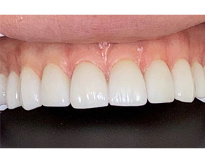 The image shows a close-up view of a person's teeth with a focus on a dental implant and surrounding natural teeth, set against a black background.