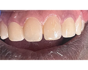 The image shows a close-up of a person's mouth with yellowed teeth and a pink tongue, displaying a wide smile against a dark background.