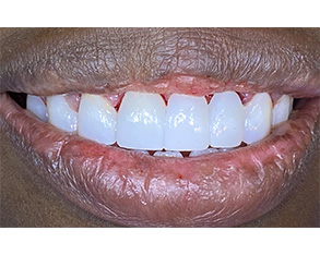 The image shows a close-up view of a person's mouth with teeth stained yellow, and they are smiling broadly.