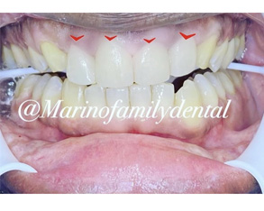 The image shows a close-up of a person s mouth with teeth showing, some of which appear to be yellowed or discolored. There is a dental implant on the upper left side of the mouth, and red markings are visible on the teeth, possibly indicating areas for treatment or repair.