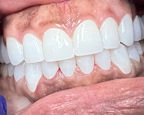 The image shows a close-up view of a person's teeth with a focus on a dental implant, set against a background that includes part of the person's face and chin.