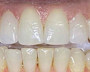 The image shows a close-up of a person's teeth with a focus on dental treatment, specifically a set of white fillings.