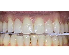 The image shows a close-up view of a person's teeth with a focus on a yellowish discoloration, likely from staining or decay, against a white background.