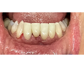 The image shows a close-up of an open mouth with visible teeth and gums, displaying a person's dental condition.