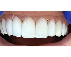 The image shows a close-up view of a person's teeth with a bright smile, featuring white, straight teeth, and a blue background.
