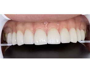 The image shows a close-up of a person s teeth with a focus on a dental implant, highlighting the contrast between the natural and artificial teeth.