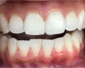 The image shows a close-up view of a person's teeth with a focus on a large gap between two front teeth, which appear to be missing or misaligned, and the surrounding gum tissue appears inflamed or affected by decay.