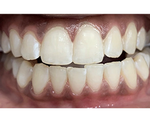 The image shows a close-up of a person's teeth with a yellowish hue, which may suggest discoloration or staining.
