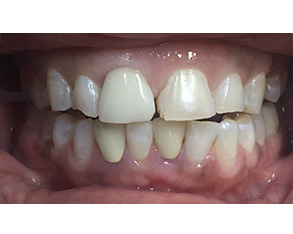 The image shows a close-up of a person's teeth with visible signs of decay and staining, indicating poor oral hygiene.