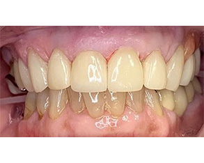 The image displays a before-and-after comparison of a dental treatment, showing a person's teeth with significant decay on the left side before treatment and the same teeth appearing cleaner and healthier after treatment.