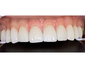 An up-close photograph of a person's teeth showing a significant amount of dental work with white fillings and crowns, set against a black background.