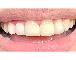 The image shows a close-up of a person's smiling mouth with white teeth, displaying a wide smile, against a plain background.