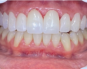 The image shows a close-up of a person s mouth with teeth showing, including a lower front tooth that appears damaged or worn down, set against a white background.