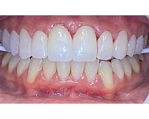 The image shows a close-up of a person's teeth with a focus on cosmetic dental work, specifically a smile makeover, highlighting the transformation from discolored teeth to clean, well-maintained teeth.