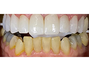The image displays two views of a dental implant with a yellowish hue, showcasing its color change over time.