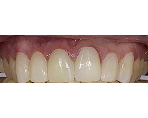 The image shows a close-up view of a person's teeth, with the top row appearing yellowed and the bottom row appearing clean and white, suggesting dental cleaning or treatment.
