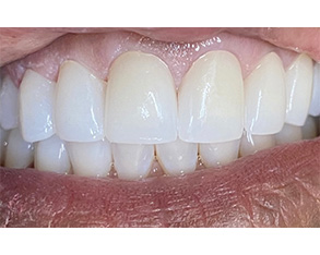 The image shows a close-up of a person's teeth with a focus on their lower front teeth, which appear to be yellowed and possibly stained.