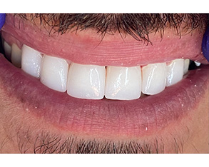 The image shows a close-up of a person's smile with white teeth, and there appears to be a purple object near the mouth.