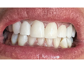 The image shows two photographs side by side: on the left, a close-up of a person's teeth with noticeable yellowing and staining, indicating poor dental hygiene; on the right, the same person's mouth after professional dental cleaning, revealing clean, white teeth.