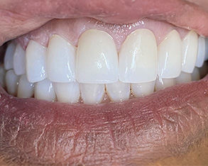 The image shows a close-up view of a person s teeth with a focus on a wide smile, revealing white teeth and gums.
