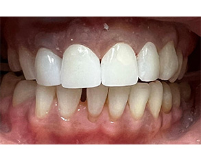 The image shows two photographs of an individual's teeth with varying levels of dental health, likely for educational or informational purposes related to oral hygiene or dental care services.