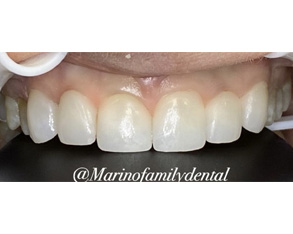 The image shows a close-up view of a person s teeth with visible dental work, including braces and possibly veneers or crowns, against a black background.