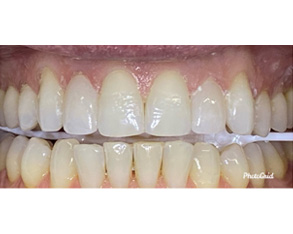 The image shows a close-up view of teeth with varying shades of yellowing, some with stains, indicating a need for dental care or whitening.