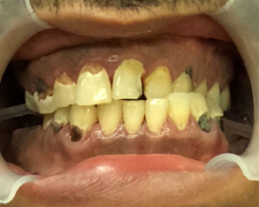 The image shows a person with their mouth open, revealing severely decayed teeth and an overbite, with part of a dental treatment device visible inside the mouth.