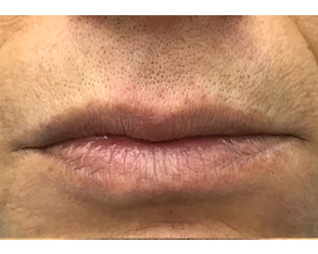 The image shows a close-up of a person's face with a focus on their lips and chin.