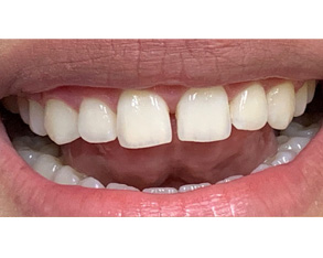 The image shows a person with an open mouth revealing teeth, wearing lipstick, with a portion of their face visible.