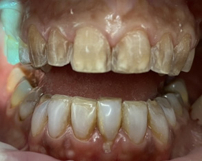 The image displays a close-up view of a person s mouth with severely decayed teeth, showcasing extensive dental damage and neglect.