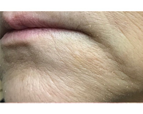 The image shows a close-up view of a person's face with visible signs of aging, such as wrinkles and sagging skin, particularly around the mouth area.