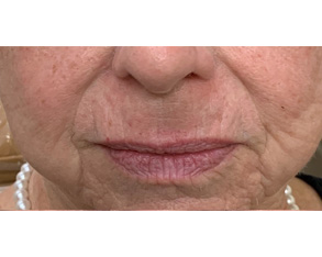 The image shows a close-up of an individual's face with visible signs of aging, including wrinkles and age spots, with a 'Do Not Enter' sign superimposed over the mouth area.
