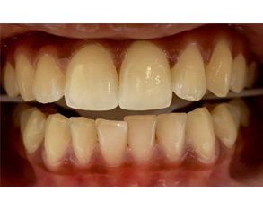 The image displays a close-up view of a person's teeth with a focus on dental decay and discoloration, set against a plain background.