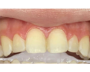 The image shows two different views of a mouth with teeth that have been altered for cosmetic purposes, likely through dental procedures such as veneers or orthodontic work.