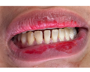 A close-up photograph of a person with mouth open, revealing a smile with red lipstick smeared across their teeth, set against a plain background.
