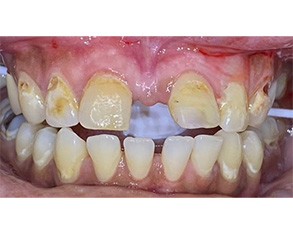 This image shows two views of an oral cavity with teeth that appear yellowed and discolored, suggesting possible dental issues such as staining or decay.