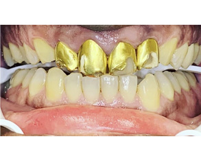 The image shows a pair of human teeth with gold crowns, displayed against a plain background.