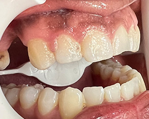 The image shows a close-up view of an open mouth with yellowed teeth and visible gum disease, which includes red, inflamed gums and plaque buildup.