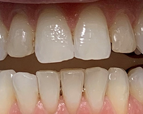 The image shows a close-up view of a person's teeth with a focus on the front teeth, which appear to be veneered or cosmetically enhanced, set against a pink gum line.