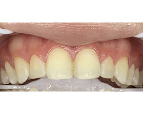 The image shows a close-up of a person s teeth with significant decay and damage, emphasizing the need for dental care and restoration.